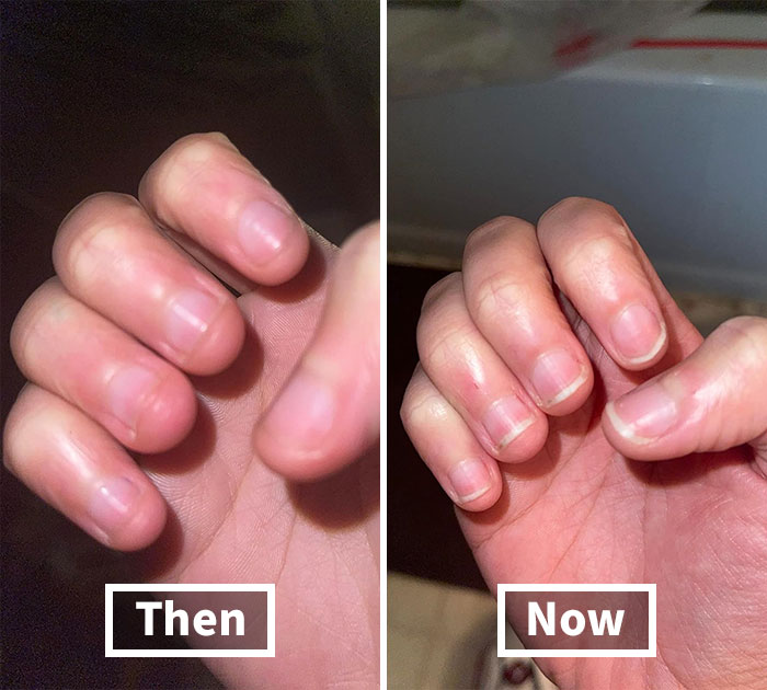 Close-up comparison of fingernails showing progress symbolizing 2025 success starts now goal pursuit steps.
