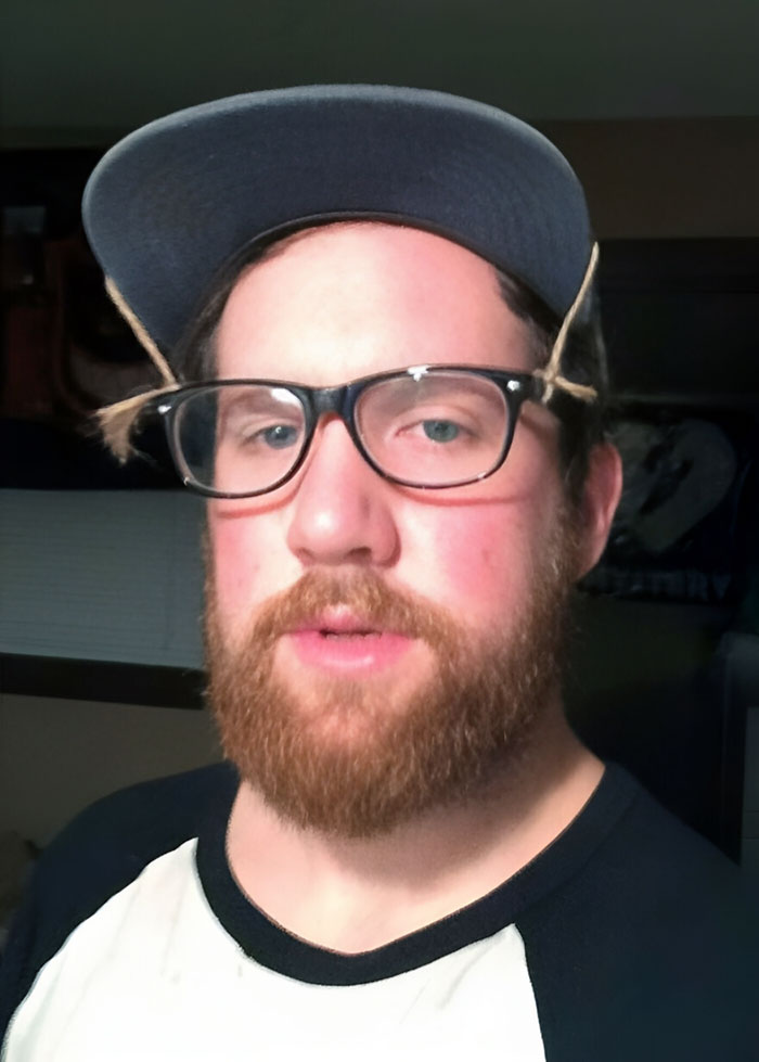 I'm Healing From A Septoplasty, And I'm Not Allowed To Wear Glasses As They Put Too Much Pressure On My Nose, So I Rigged Up A System