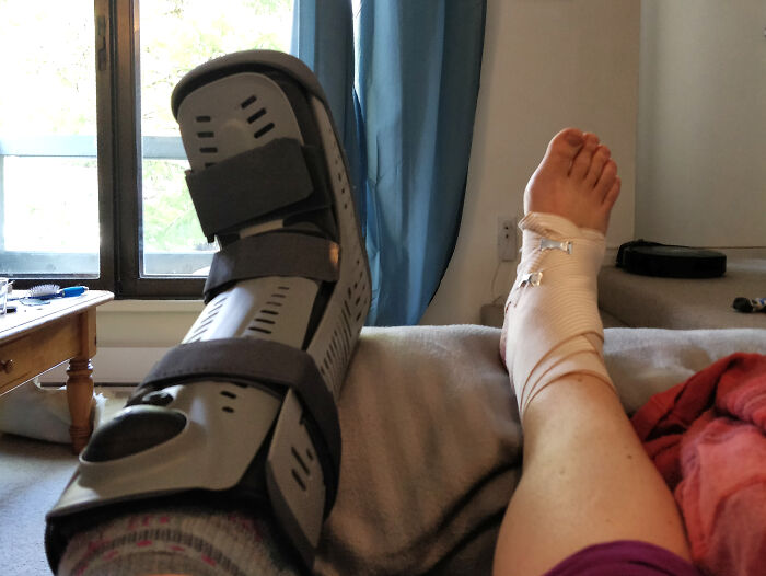 Person resting with a leg in a medical boot and a bandaged foot, representing memorable stranger experiences shared online.