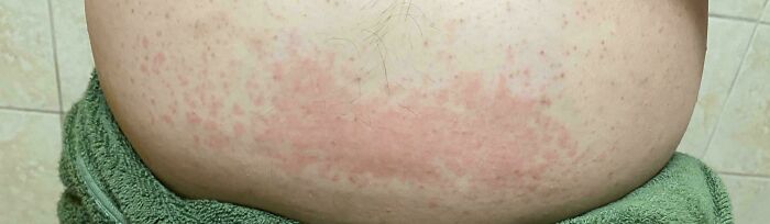 Got Zapped By Static Electricity From A Conveyer At Work