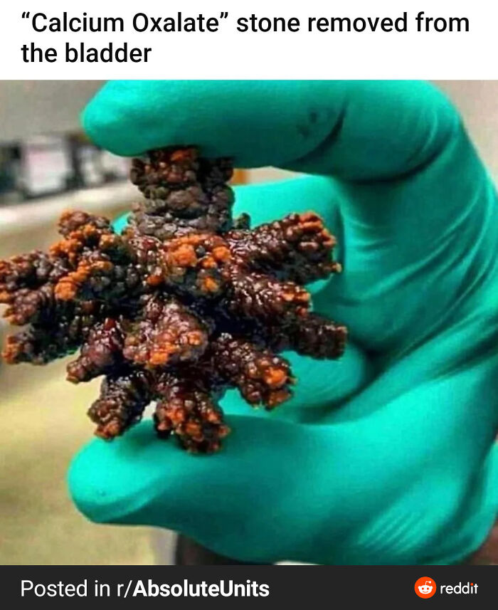 Gloved hand holding large calcium oxalate stone removed from the bladder, one of the most terrifying and disturbing images.