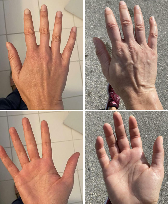 My Fingers Get Very Swollen When I Exercise