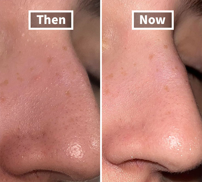 Giving You That 'Just Woke Up Like This' Look After A Night Out, Anua Heartleaf Pore Control Cleansing Oil Is Your Selfie's Unsung Hero When Makeup And Blackheads Go Bye-Bye