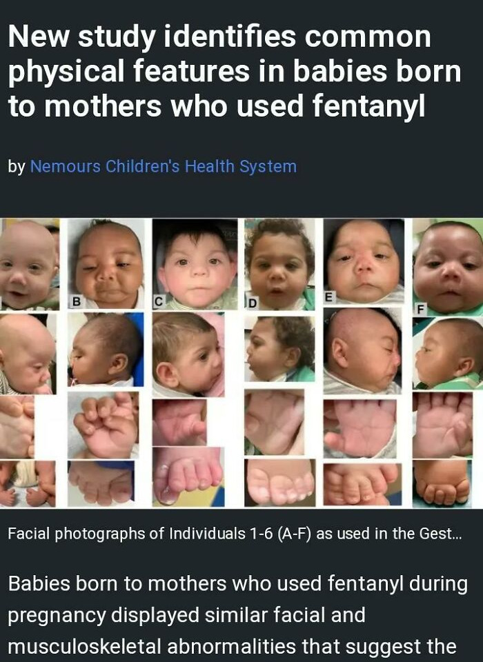 Facial and musculoskeletal features of babies born to mothers who used fentanyl, among disturbing images shared online.