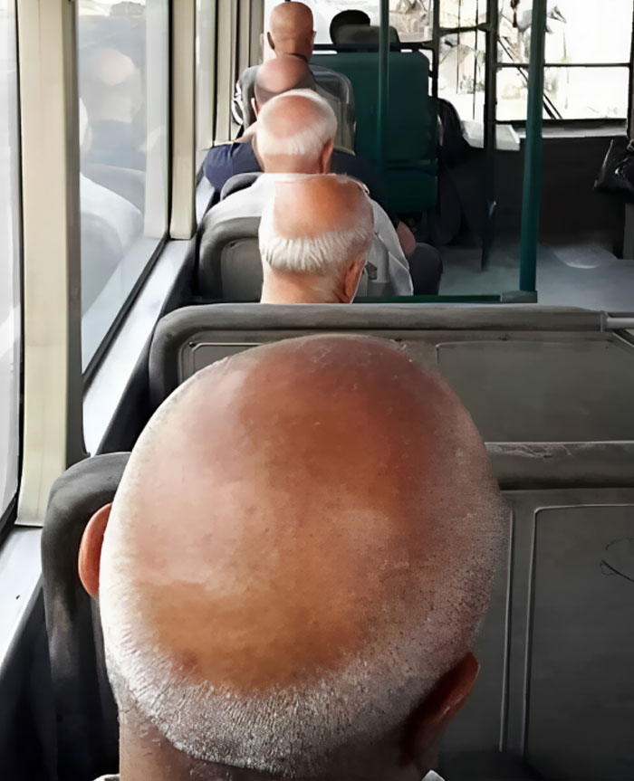 Epidemia de calvicie