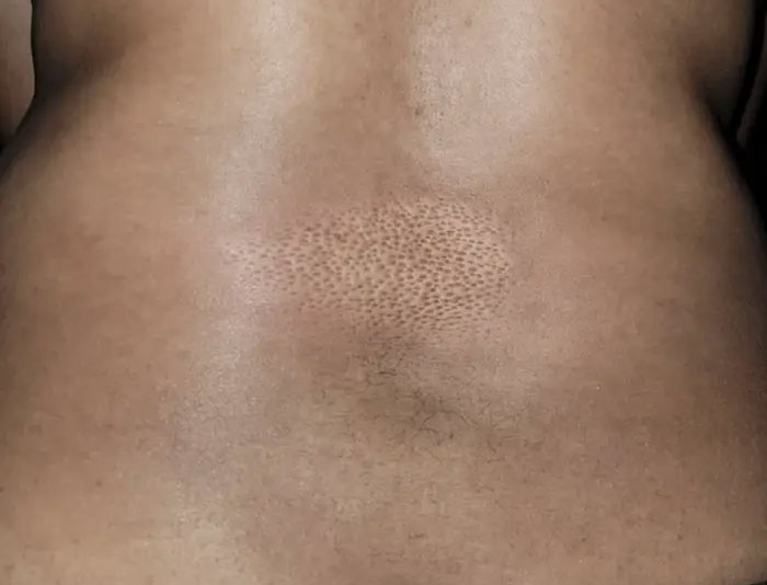 This Just Developed On My Back Anyone Know What It Is??