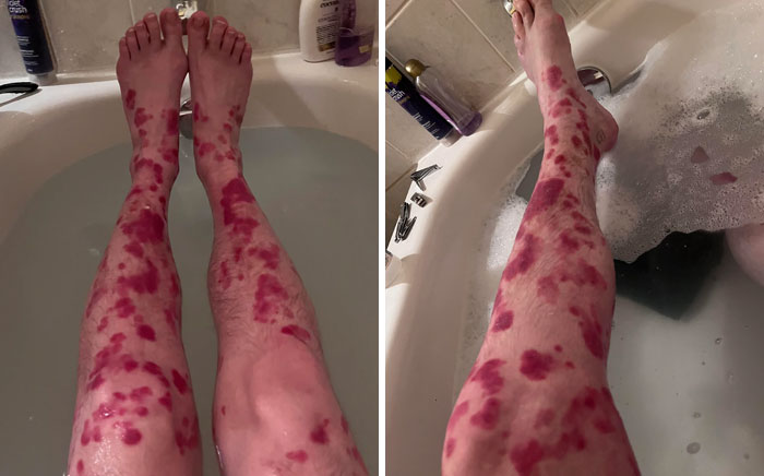 Mi psoriasis en el 97% de mi cuerpo antes de empezar el tratamiento