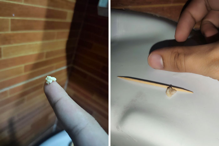 Tonsil Stone That's Been Stuck For Weeks, Finally Got It Out