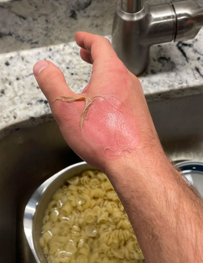 Less Than One Second Of Boiling Water - Felt Zero Pain Because It Happened So Fast