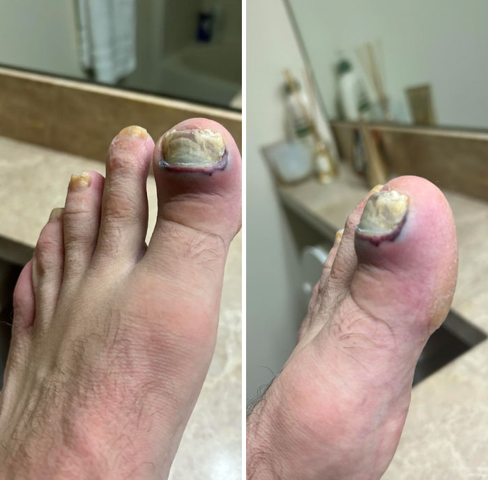 Dropped A Weight On My Fungus Toe At The Gym