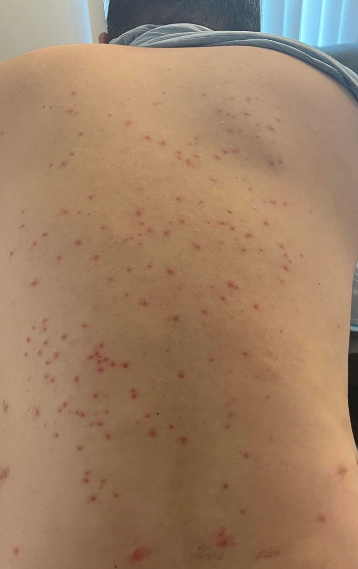 Went Surf Fishing And Served Up A Giant Meal To The Mosquitos