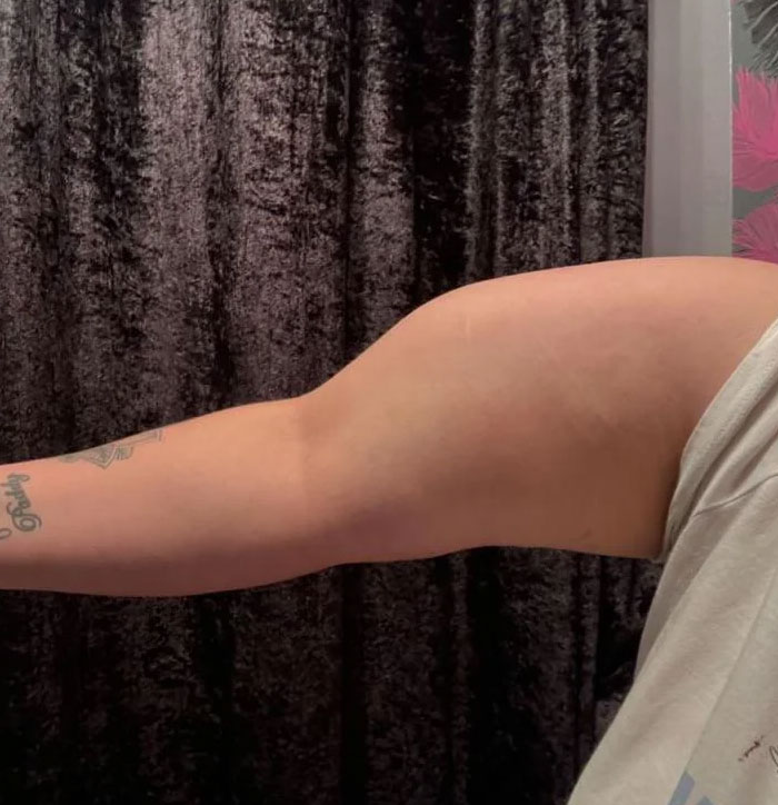 Broke My Arm A Couple Of Years Ago And This Is How It Healed