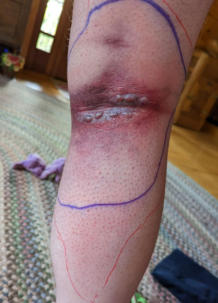 Mordedura de viuda negra