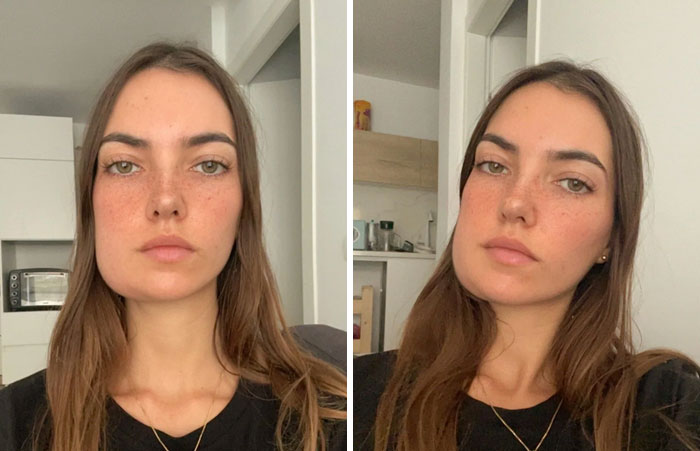 Inflamación tras sacarme un diente