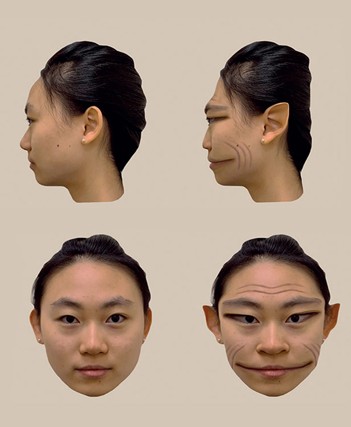 Man With Rare Disorder With Less Than 100 Reported Cases Sees People Like Demonic Figures - 2