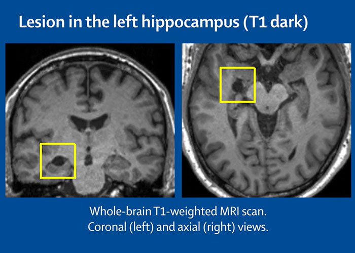 Man With Rare Disorder With Less Than 100 Reported Cases Sees People Like Demonic Figures Man With Rare Disorder With Less Than 100 Reported Cases Sees People Like Demonic Figures