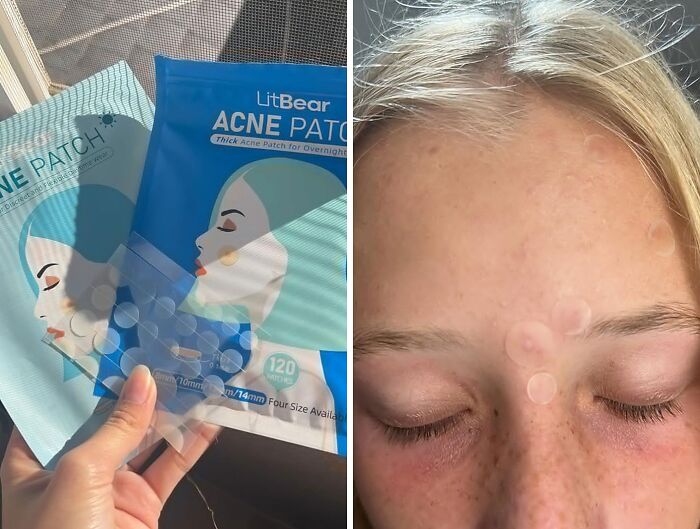 Kiss Blemishes Goodbye With LitBear Acne Pimple Patches - Your 24/7 Skincare Warrior In The Battle Against Zits!