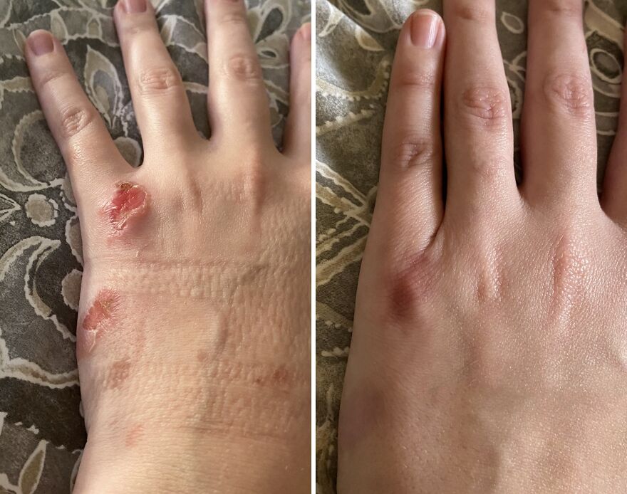 Scar Solution: Bio-Oil Skincare Body Oil, Rich In Vitamin E!