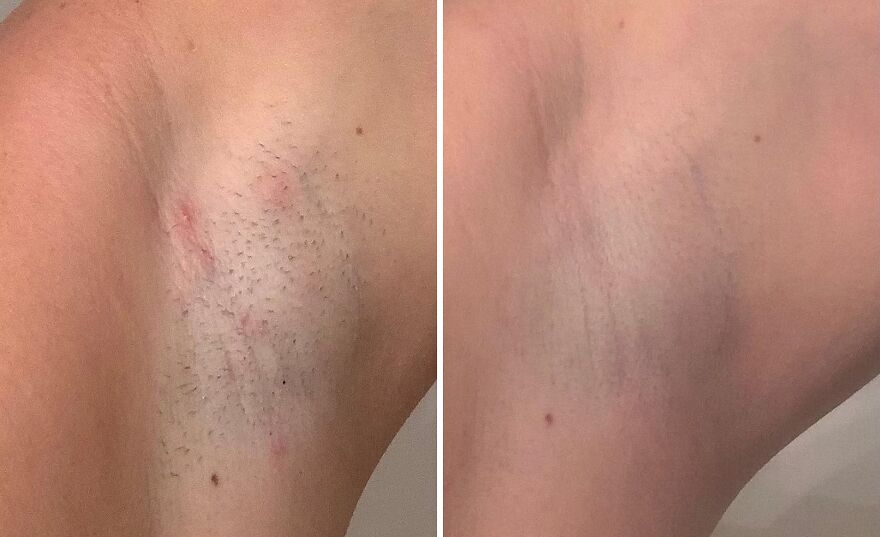 Bye-Bye Razor Bumps: Get Flawless With Fab's Aha + Bha Ingrown Hair Pads!