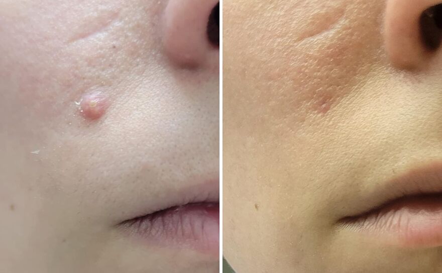 Spot On: Mighty Patch Tackles Pimples With Superhero Strength!