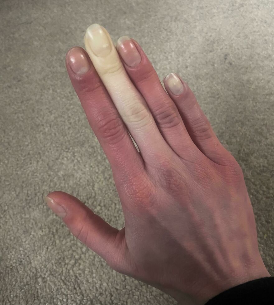 Raynaud’s Phenomenon (Vasospasm)