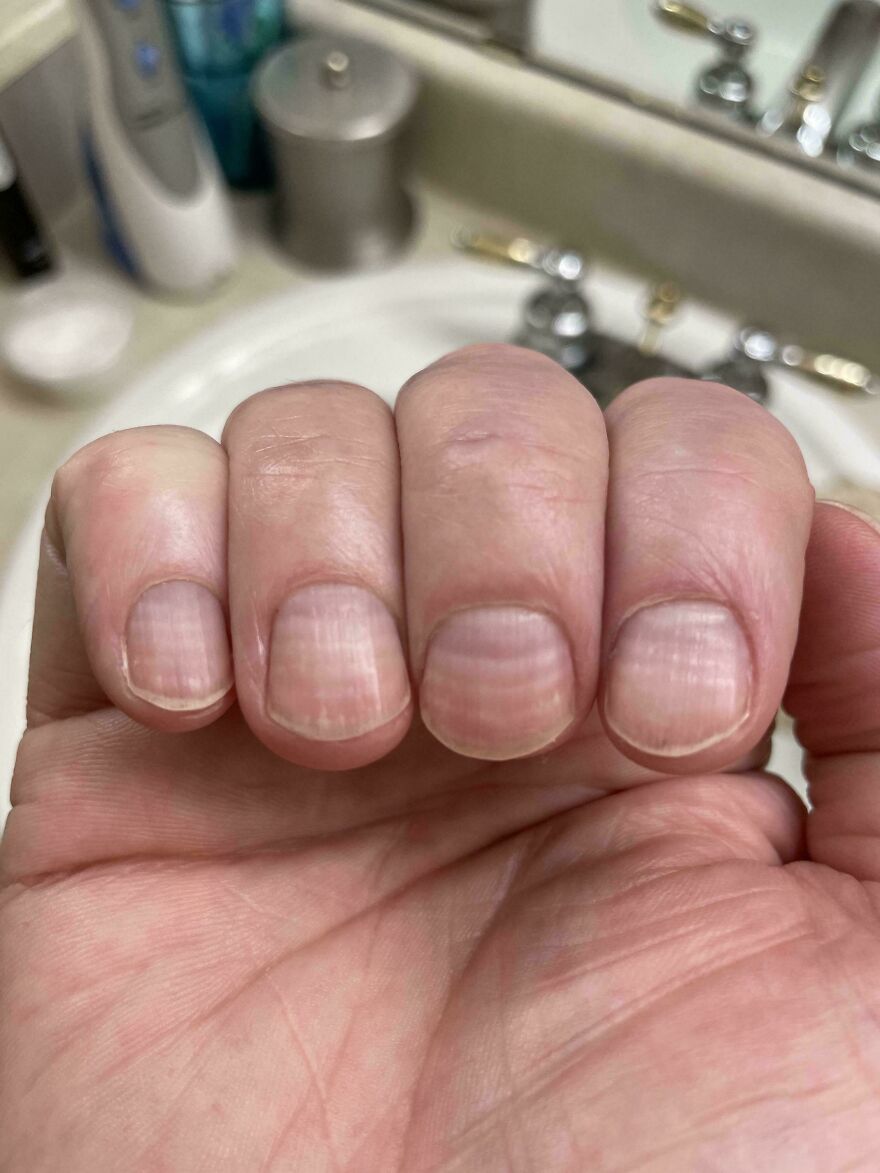 6 Lines On My Fingernails, One For Each Chemo Session I Had Recently