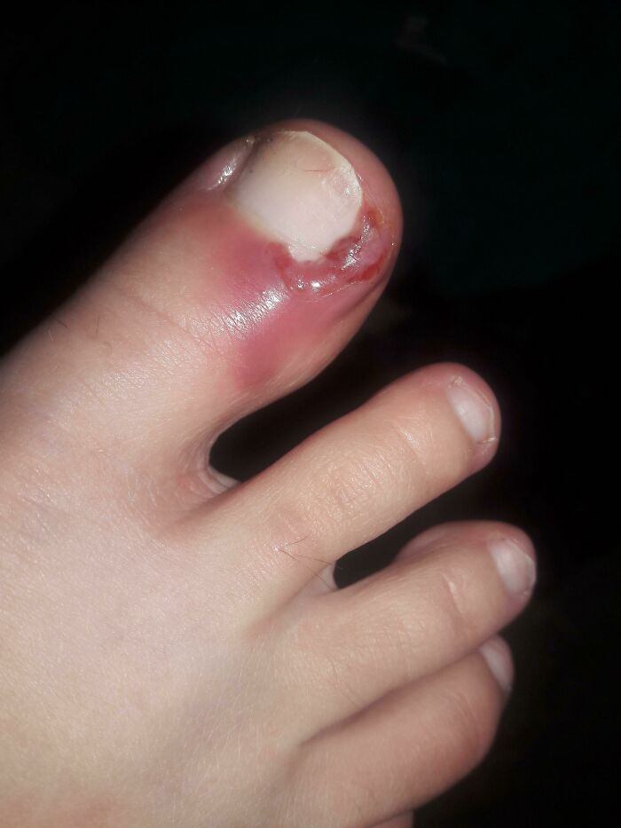 My Infected Ingrown Toenail