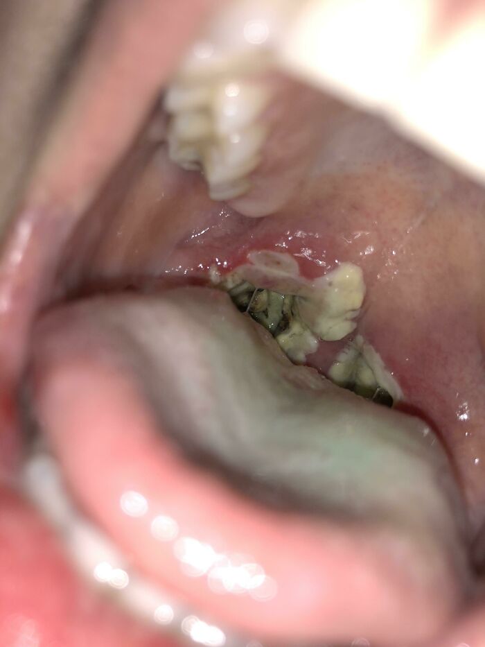 5 Days Post Tonsillectomy