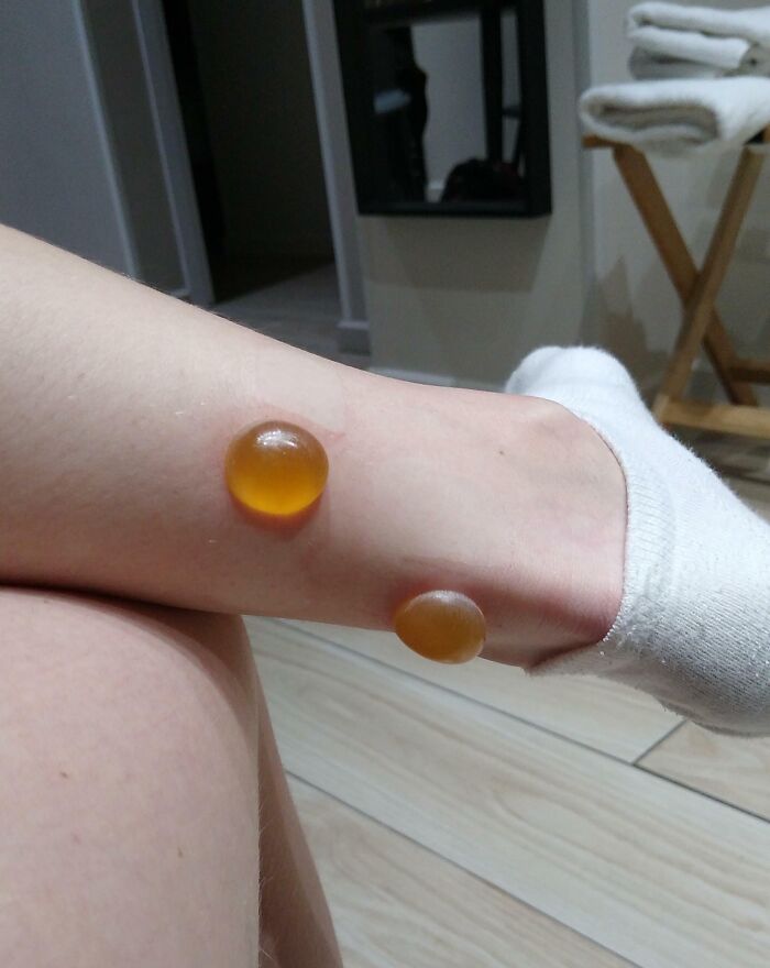 These Blisters I Got From A Mosquito Bite