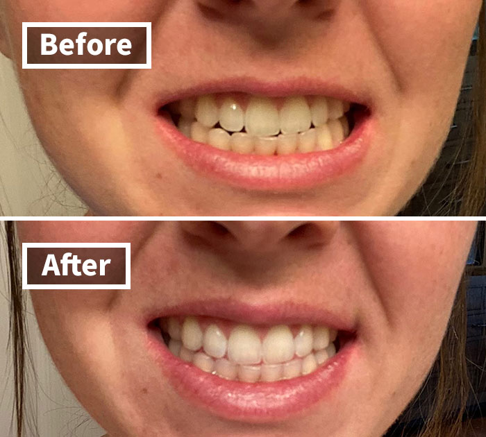 Sharpen Your Smile With The Sparkle Of 1000 Suns Using The Venus Visage Award-Winning Teeth Whitening Pen. So Efficient, It's Almost Guru-Level Enchantment Compared To Crawling Through The Crest Whitening Strips Saga