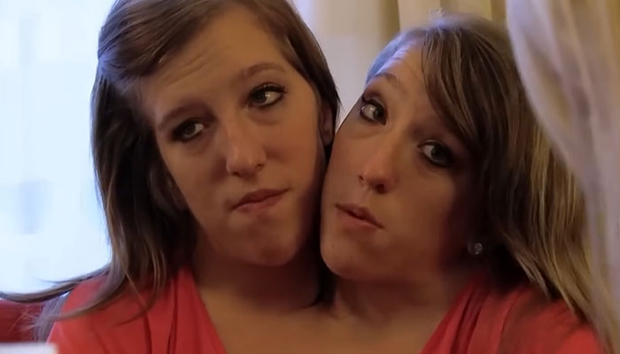 Dicephalus-Conjoined Twin Abby Hensel Of &ldquo;Abby & Brittany&rdquo; Is Married