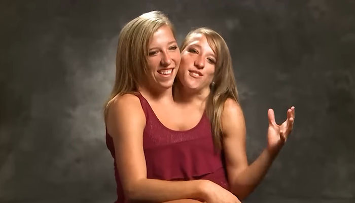 Dicephalus-Conjoined Twin Abby Hensel Of &ldquo;Abby & Brittany&rdquo; Is Married