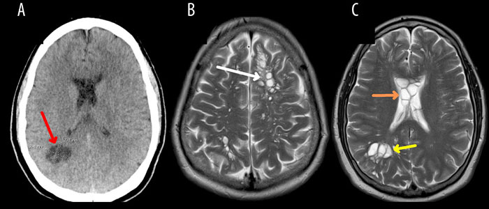 Man&rsquo;s Habit Of Eating &ldquo;Lightly Cooked&rdquo; Bacon Likely Led To Tapeworm Infection, Doctors Say