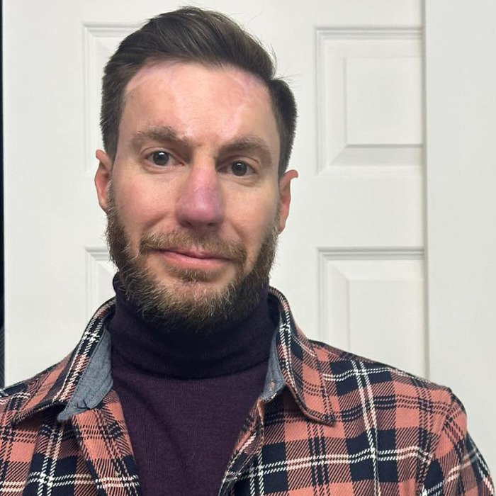 Before And After Of Man Who Received &ldquo;Amazing&rdquo; Nasal Reconstruction After Getting Mauled By Dog