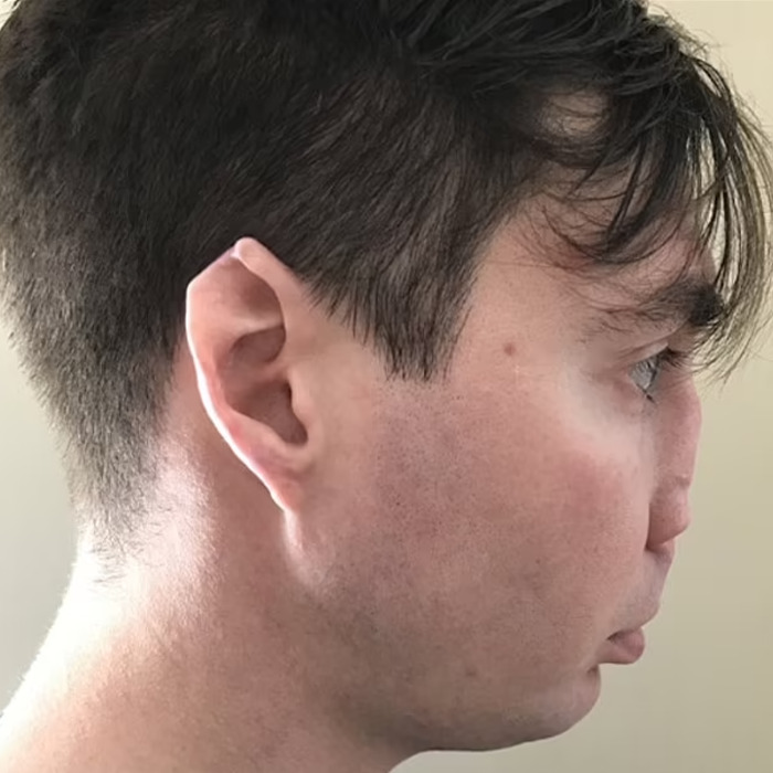 Before And After Of Man Who Received &ldquo;Amazing&rdquo; Nasal Reconstruction After Getting Mauled By Dog