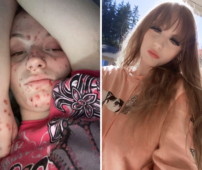 Before and after pictures of a young woman showing transformation after overcoming a*******n and skin recovery.