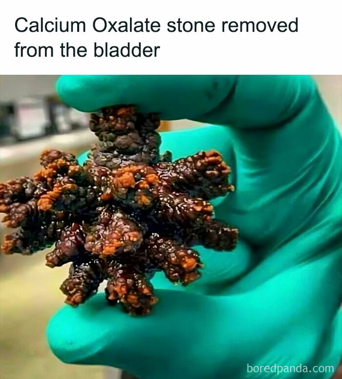 King Of The Kidney Stones