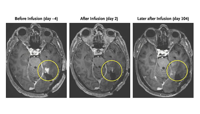 Glioblastoma Patient Sees Tumor Almost Disappear In Days Thanks To New Breakthrough Glioblastoma Patient Sees Tumor Almost Disappear In Days Thanks To New Breakthrough