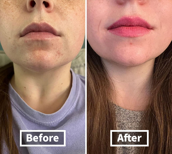 Break Up With Breakouts: Differin Acne Treatment Gel For Clearer Skin