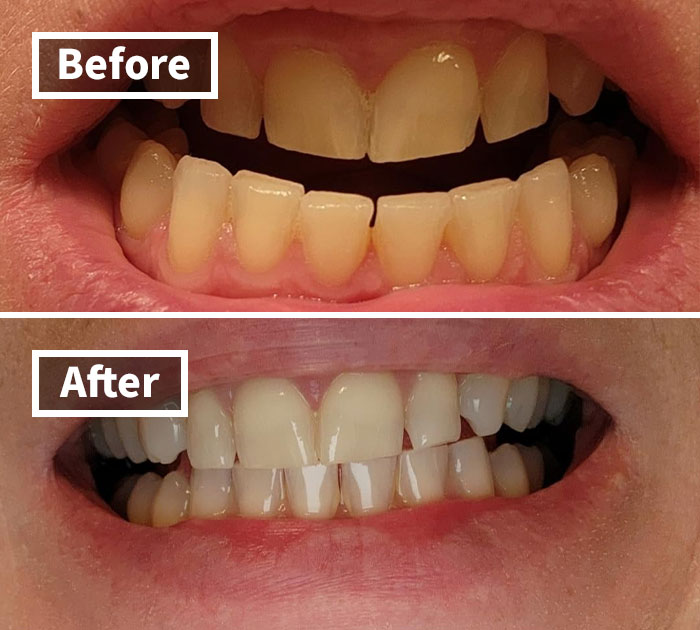 From Dull To Dazzling: Venus Visage Teeth Whitening Pen, Your Smile's Best Friend!