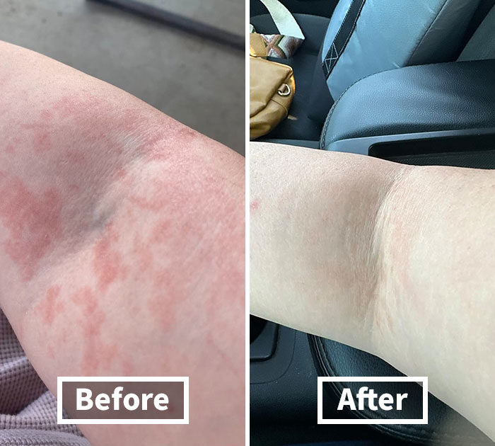 Nature’s Touch: Extra Strength Tea Tree Oil Balm, Your Skin’s New Best Friend