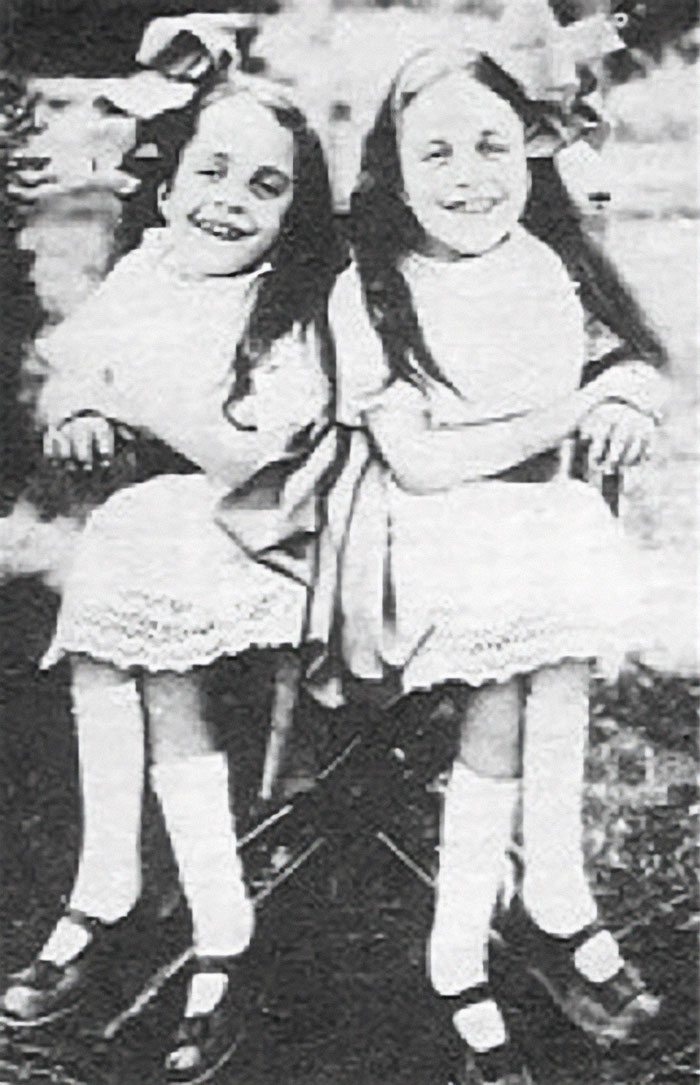 People Learn Harrowing Story Of Conjoined Twins, Which Ended With One Alive And The Other Not - 1