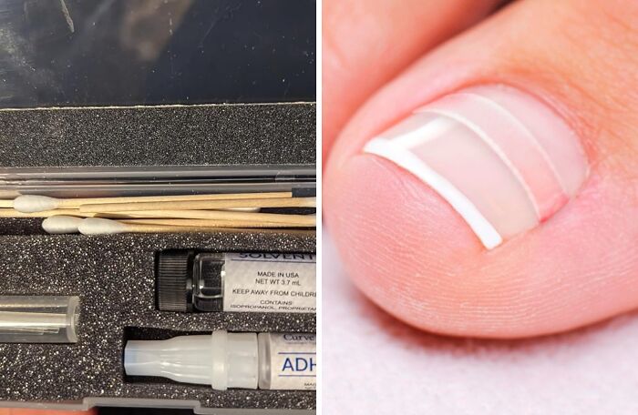 Correct Ingrown Toenails Safely With An Ingrown Toenail Correction Kit: Relieve Pain And Promote Healthy Nail Growth