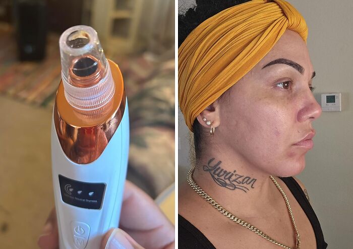 Achieve Clearer Skin With A Blackhead Remover Pore Vacuum: Gently Extract Stubborn Blackheads And Minimize Pores