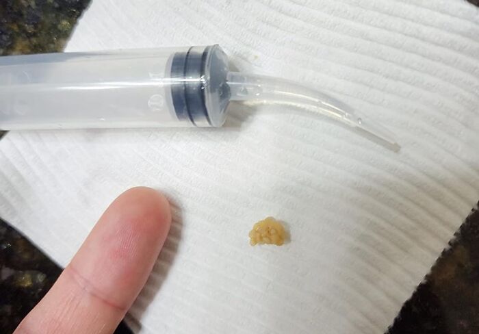 Clear The Way: Airgoesin Tonsil Stone Remover Tool For Oral Hygiene