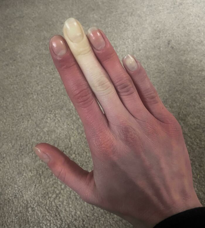 Raynaud’s Phenomenon (Vasospasm)