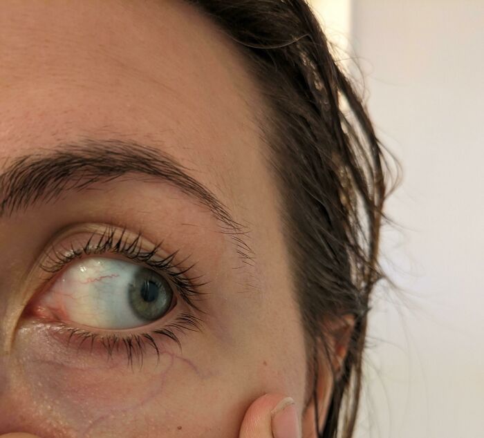 My Eye Has A Very Obvious Dark Ring