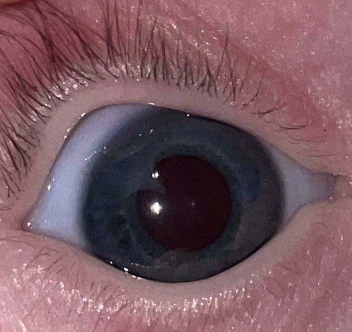 The Way My Son’s Pupil Formed