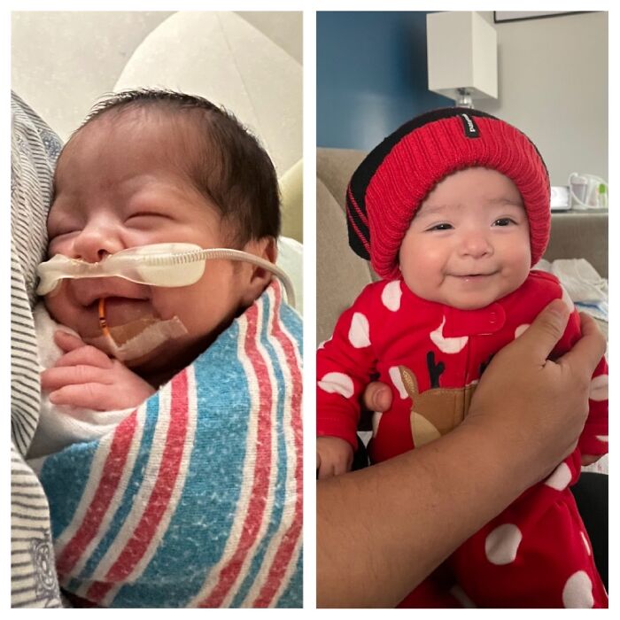 How Far We’ve Come. Born At 33 Weeks Weighing 3 Lbs To Now Over 10 Lbs. Still On The Small Side But She Keeps Growing And That’s All That Matters