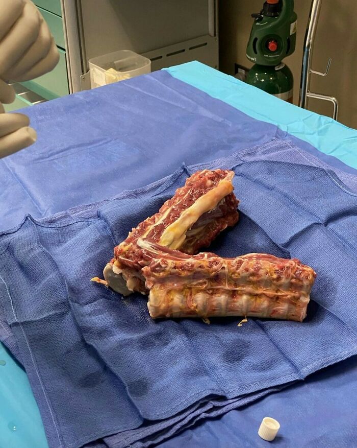Human ribs on surgical blue drape, showcasing a fascinating medical case examination.